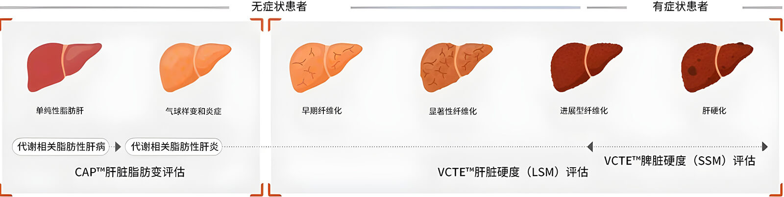 FibroScan®两大核心技术