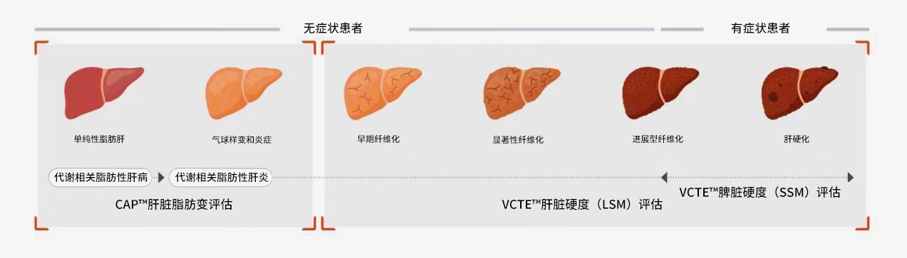 FibroScan® 检查可为各种肝脏疾病的治疗决策提供依据